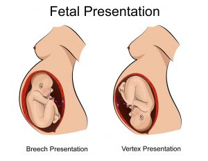Obstetrical diagram of fetal presentations, including breech presentation and vertex presentation