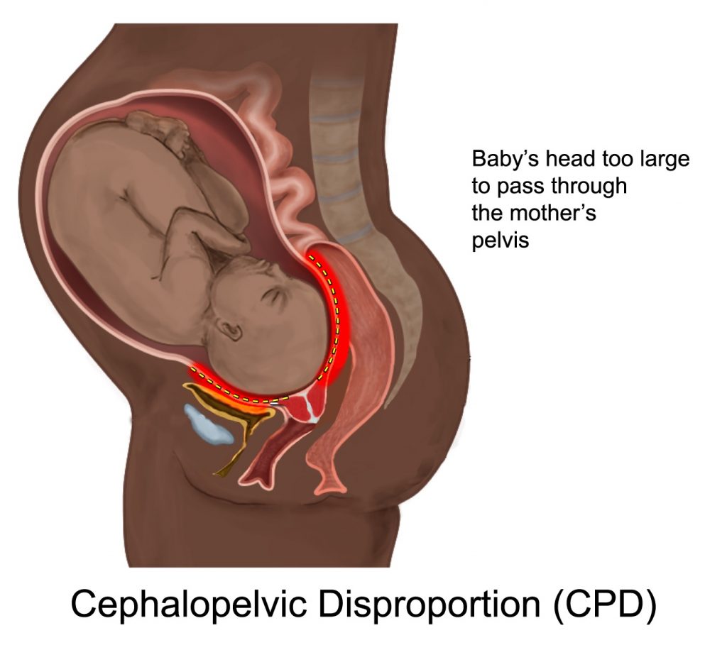 cephalopelvic-disproportion-copy