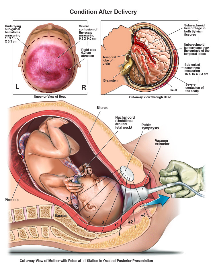 vacuum-extraction-with-fetal-head-injury